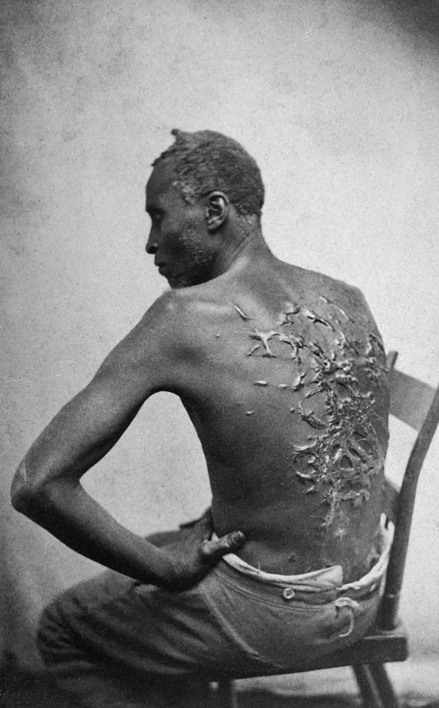 Scourged Back Mcpherson Oliver 1863 Wiki